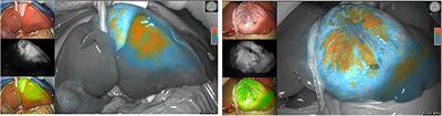 Clinical Application of Indocyanine Green Fluorescence Imaging in the Resection of Hepatoblastoma: A Single Institution's Experiences